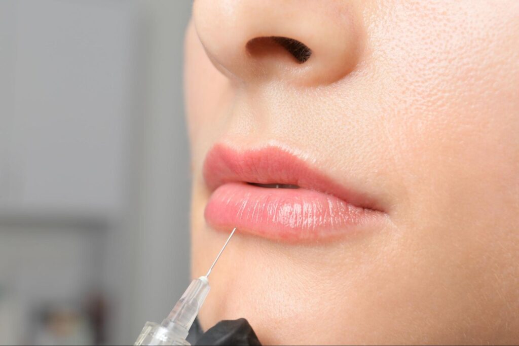 hialuronidasa labios corregir relleno