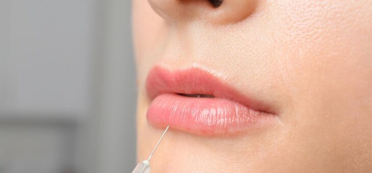 Rellenos de labios que corregimos en consulta: migración, sobrellenado y hialuronidasa